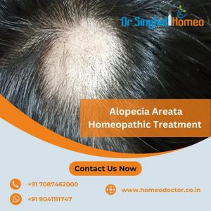 Alopecia areata starts with small bald patches. The underlying scalp skin is unscarred and looks sup