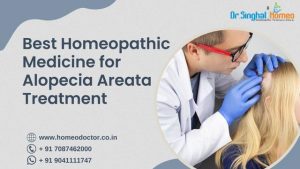 Are you searching for Alopecia Areata homeopathic treatment? Then you are at the right spot. Alopeci