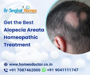 Alopecia Areata is an autoimmune disease where the person loses hair from one or more spots on the s