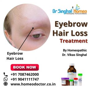 Eyebrow loss can dampen your self-esteem significantly since it enhances your overall face. Thinning