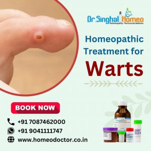If you want to cure your wart problems permanently, choose homeopathy. Homeopathic Treatment for War